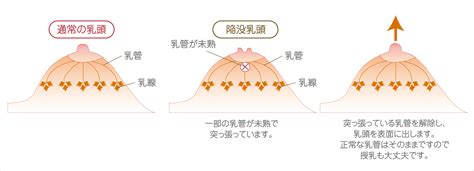 乳頭生毛|乳頭內凹、長毛正常嗎？ 8類「乳頭形狀」你的是哪種